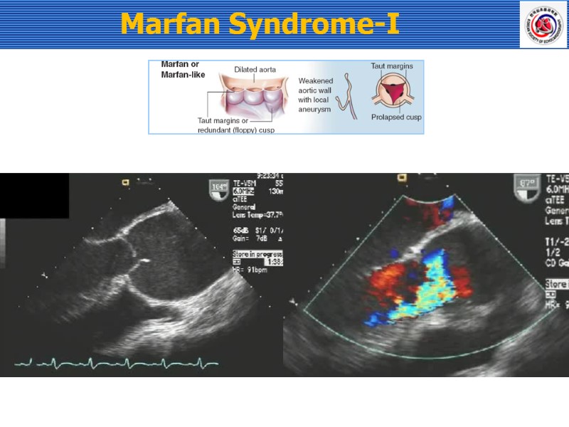 Marfan Syndrome-I